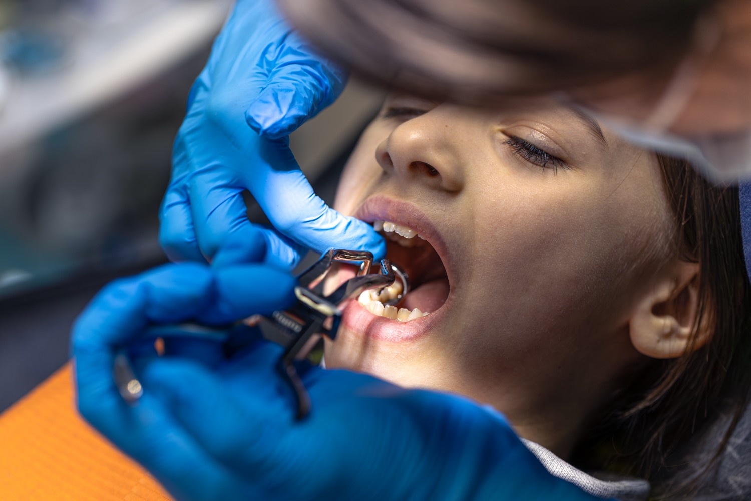 Best Dental Surgeon in Faridabad for Root Canals